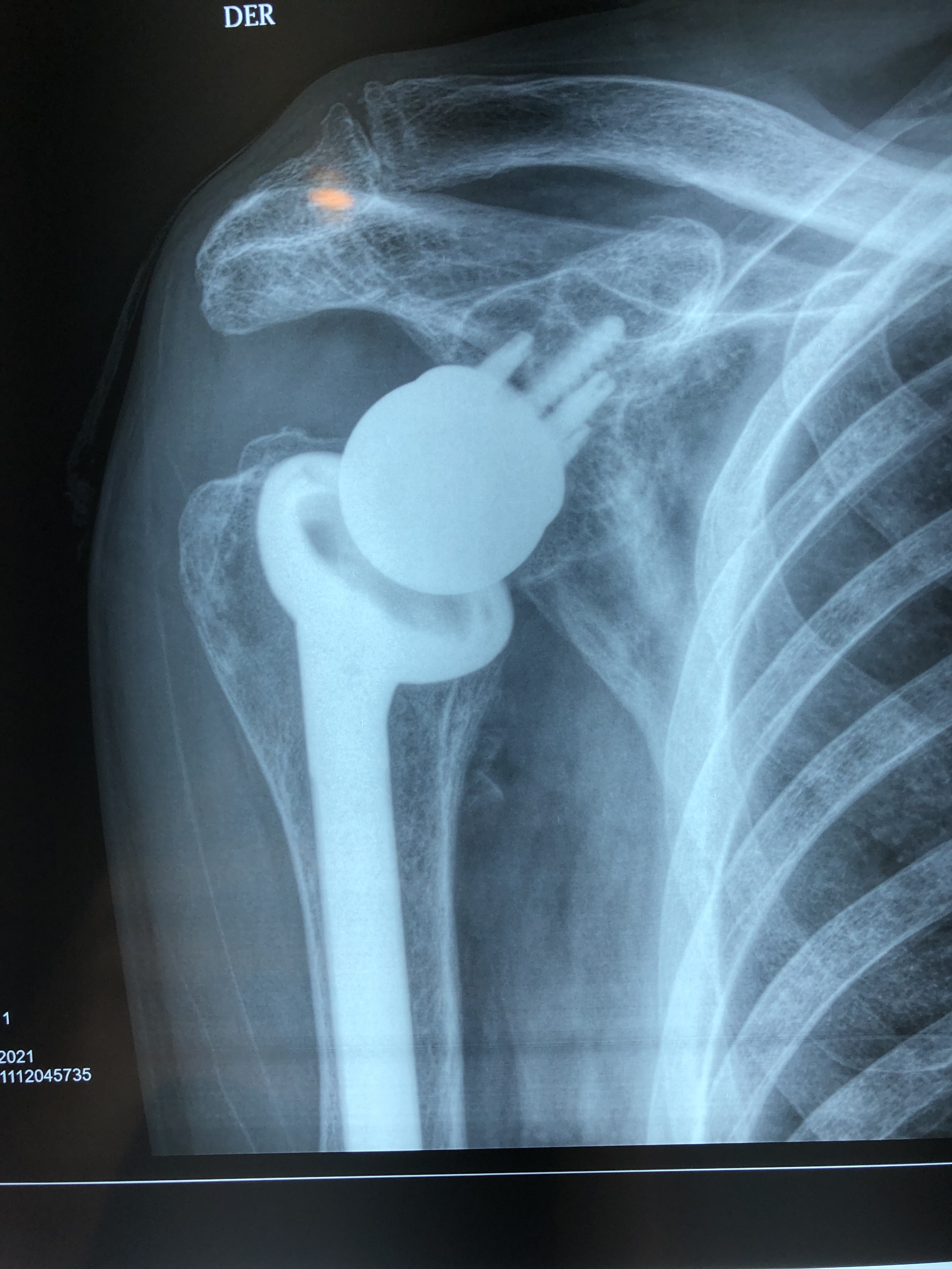 Prótesis Reversa De Hombro 