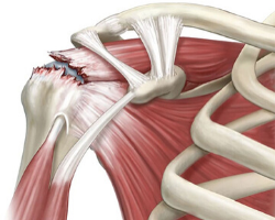 Artroscopia de hombro Reparación de mango rotador