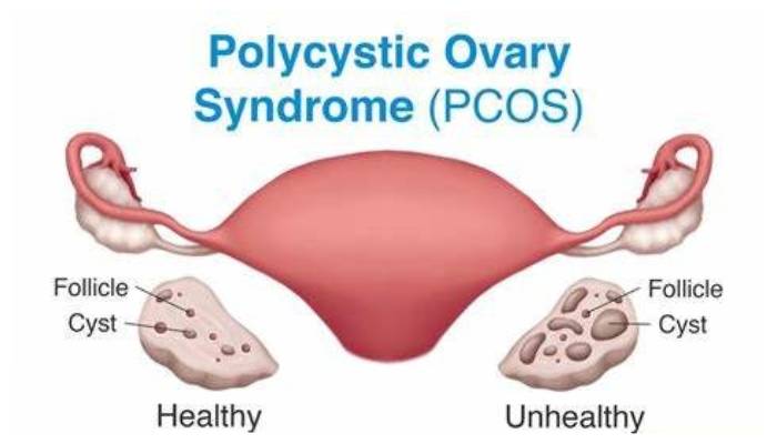 Adolescent PCOS reversal plans