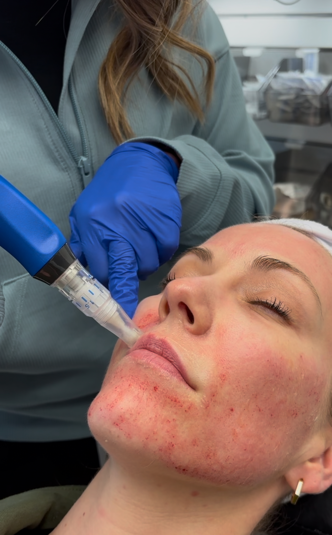Microneedling