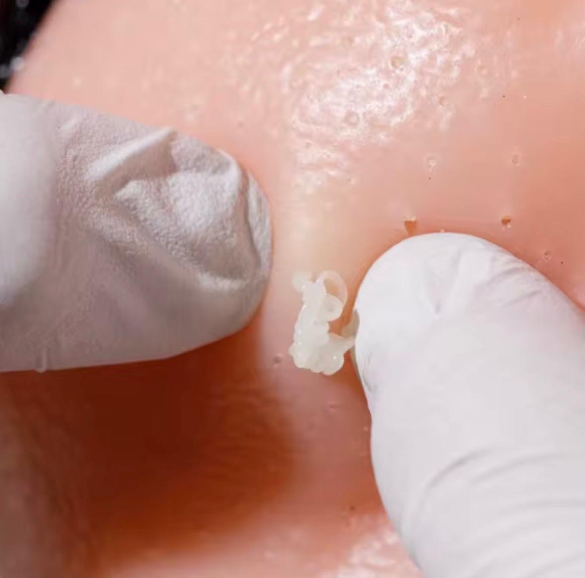 PopDaddy - Pimple Popping Fidget Toy Kit (Include 1 refill Pack)