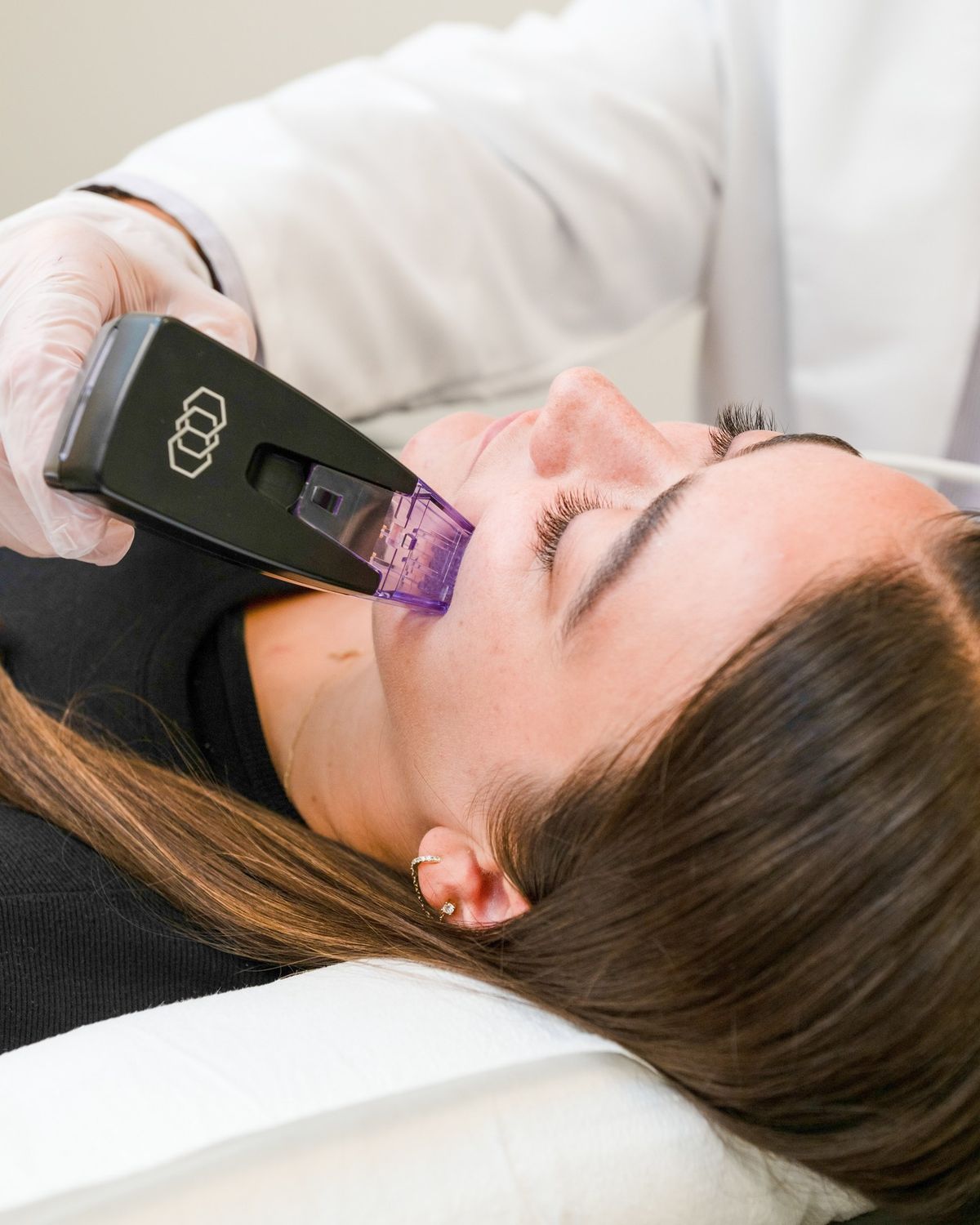 MNRF (Microneedling Radiofrequency)