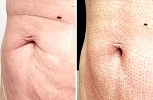 TRATAMIENTO DE ESTRÍAS POST-PARTO · PLASMA PEN