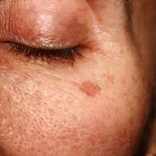 Fibroblast · Manchas Faciales Localizadas