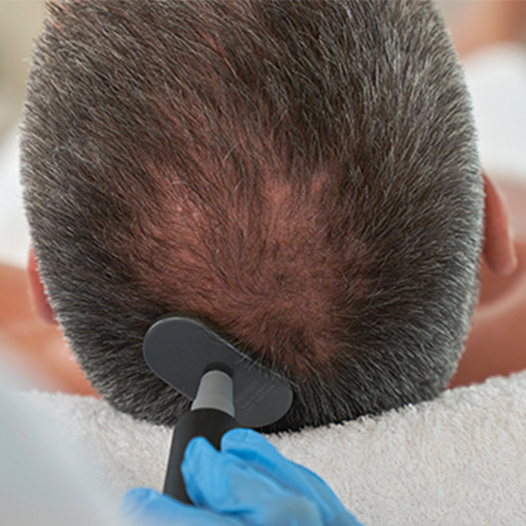 Indiba Capilar · Estimulación y Regeneración del Folículo (6 SESIONES)