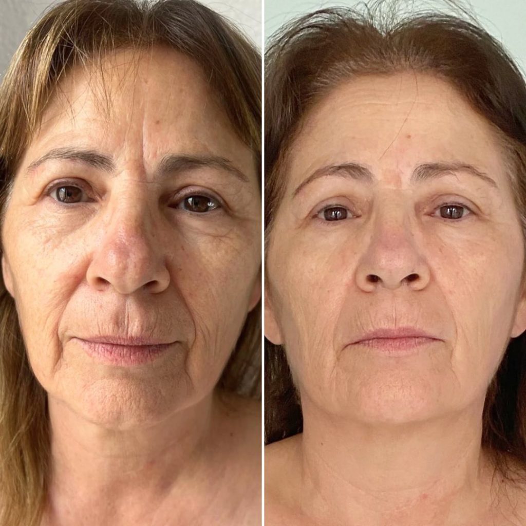 HIFU Facial Nueva Generación · Efecto Lifting