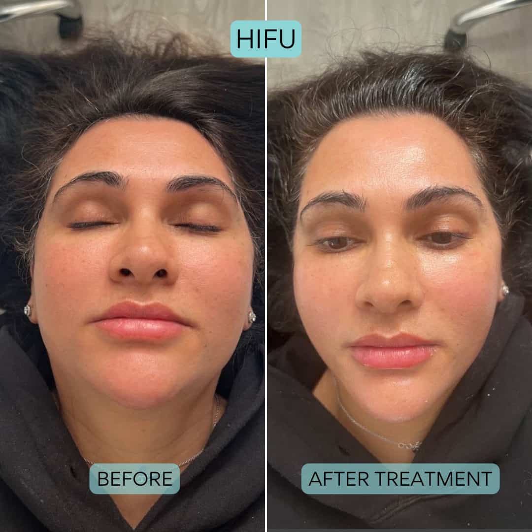 HIFU Facial Nueva Generación · Efecto Lifting