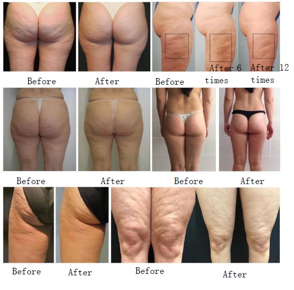 ENDOSFERAS + PRESOTERAPIA · Programa Remodelación (5 SESIONES DE CADA)