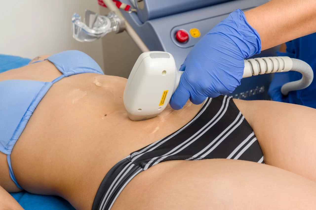 Zona Abdomen y Pecho · Depilación Láser SHR — Bono 5 sesiones