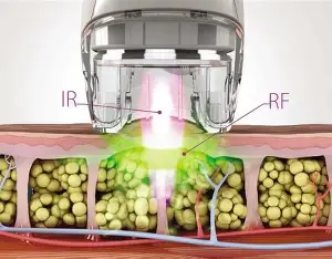 Glow Lift · Preparación de la Piel para Eventos