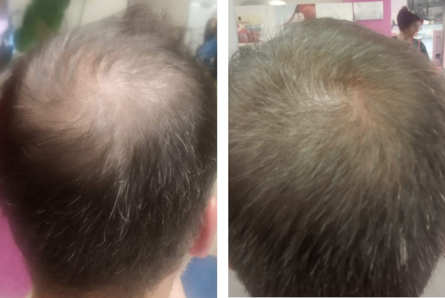 Programa Capilar Intensivo · Estimulación Avanzada