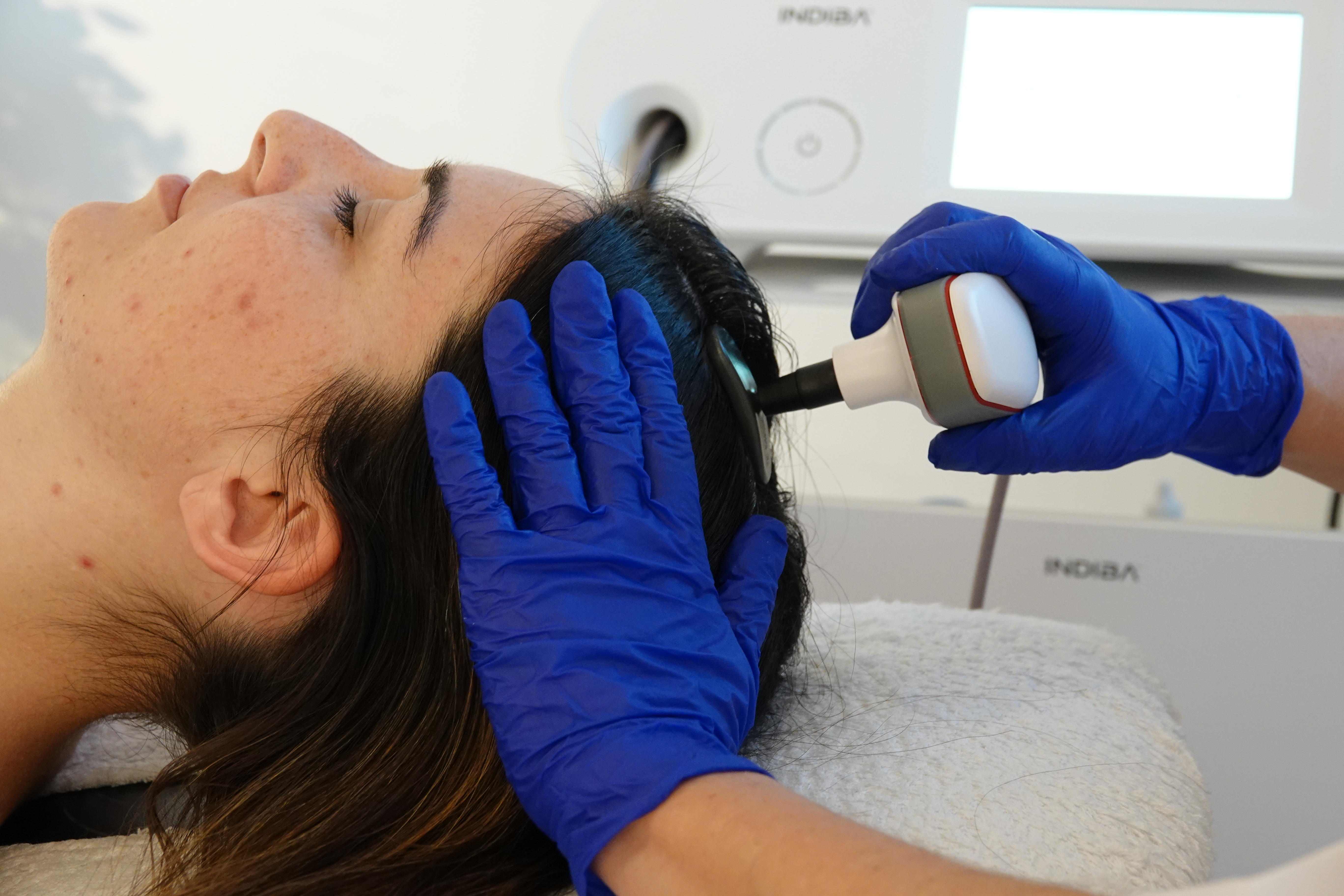 Indiba Capilar · Estimulación y Regeneración del Folículo (6 SESIONES)