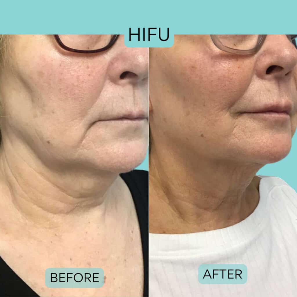 HIFU Facial Nueva Generación · Efecto Lifting