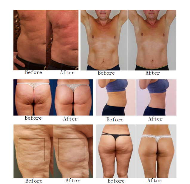 ENDOSFERAS + PRESOTERAPIA · Programa Intensivo Remodelación (10 SESIONES DE CADA)