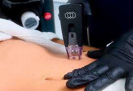 Rejuvenecimiento Profundo · RF Fraccionada Zona Mediana