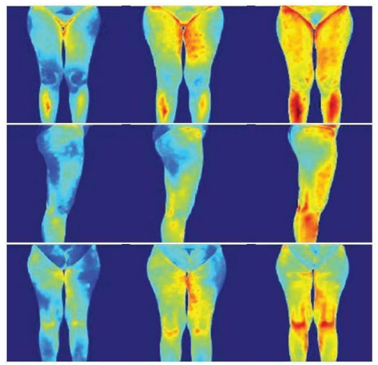 DIAGNÓSTICO CORPORAL AVANZADO · Cámara Térmica