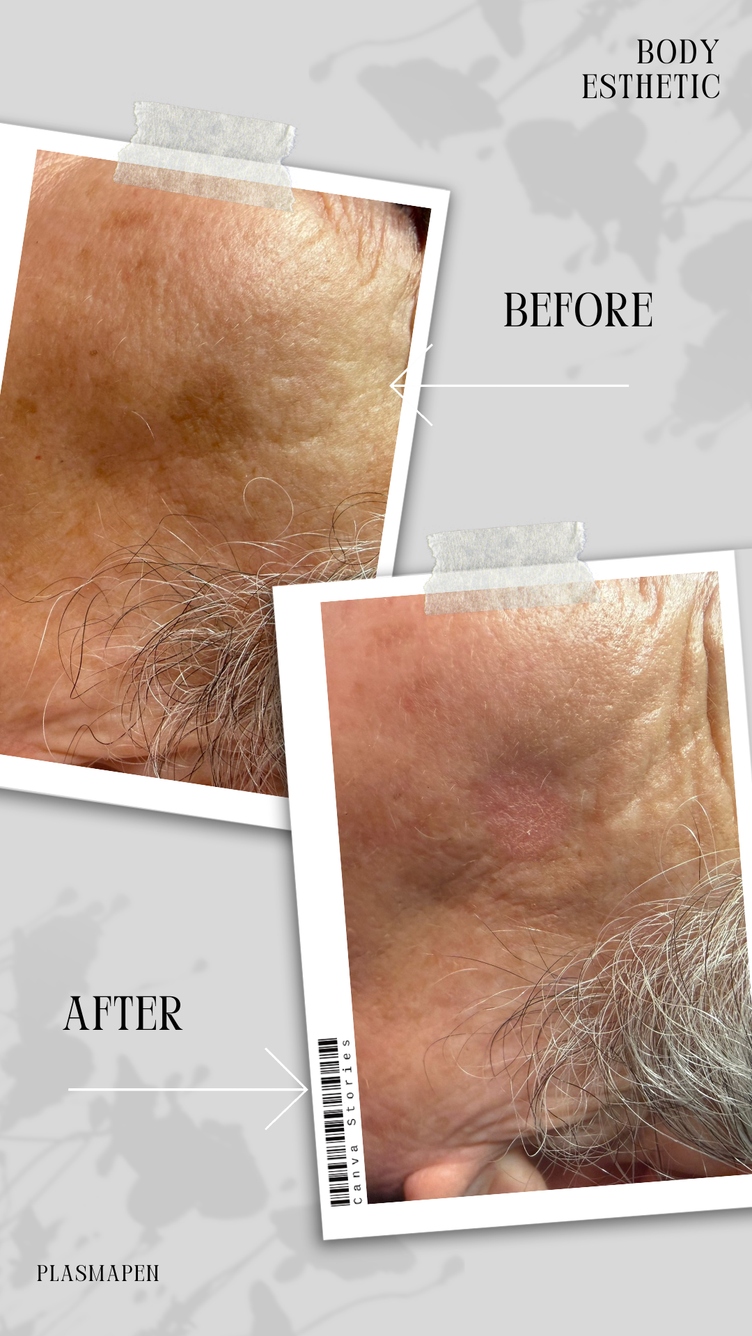 PLASMA PEN · Manchas Benignas