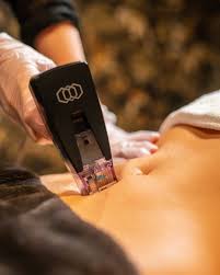 Rejuvenecimiento Profundo · RF Fraccionada Zona Mediana