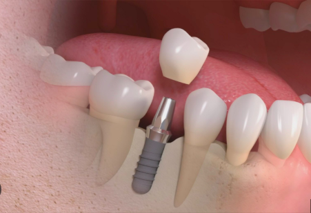 Dental Implant