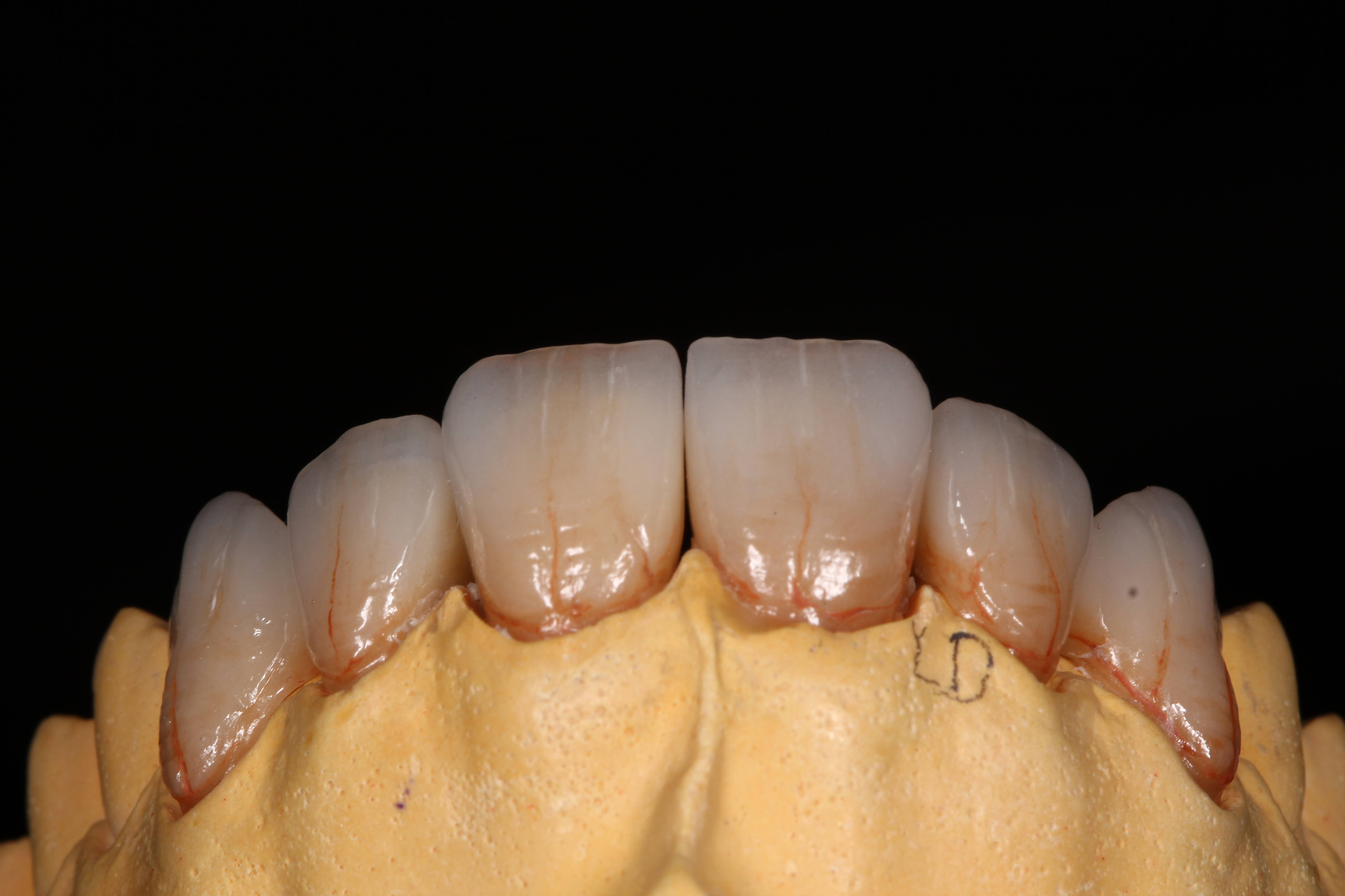  Zirkonoxid mit Keramikvollverblendung