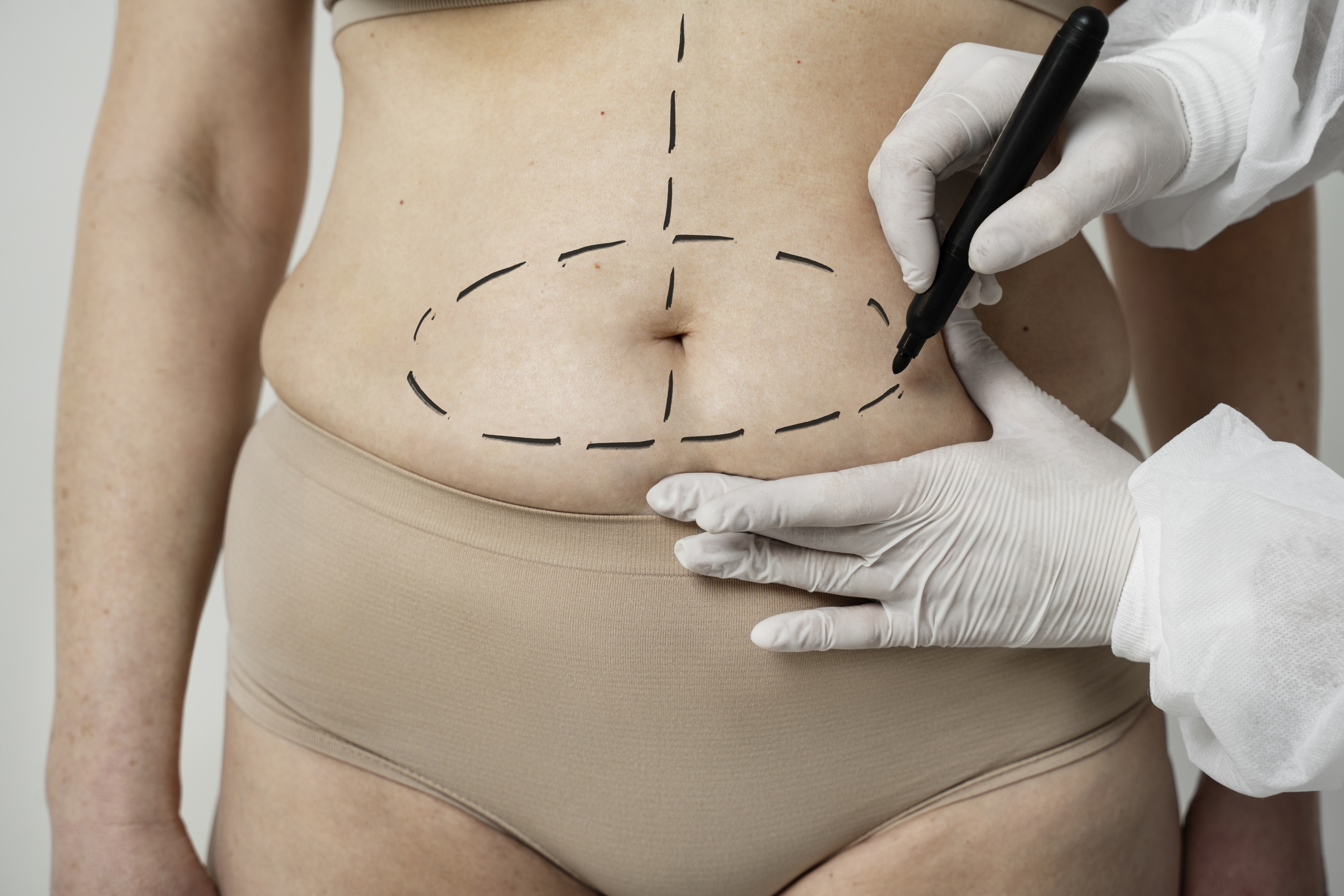 Tummy Tuck