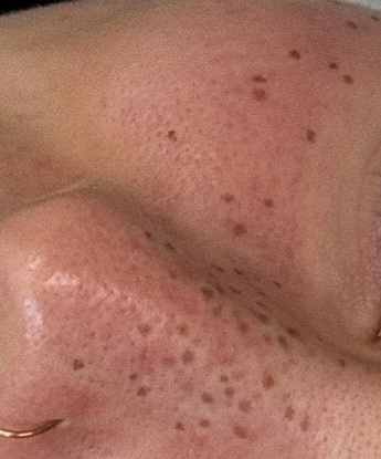 Freckle & Beauty Spot Tattooing