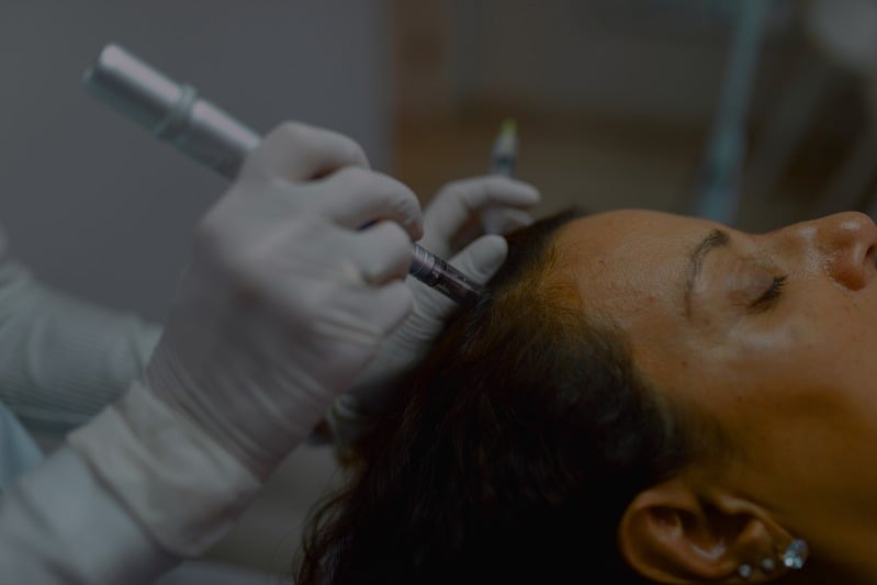 PRP Microneedling Hair Regrowth Treatment 