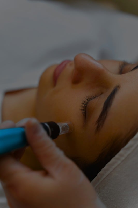 PRP Microneedling Under-Eye Rejuvenation 