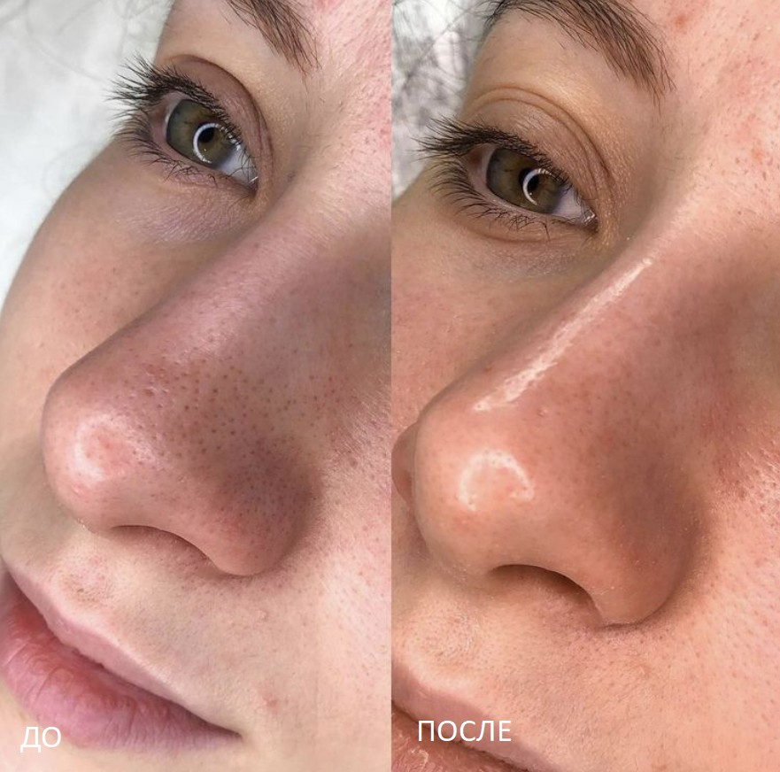 Hydrafacial Treatments