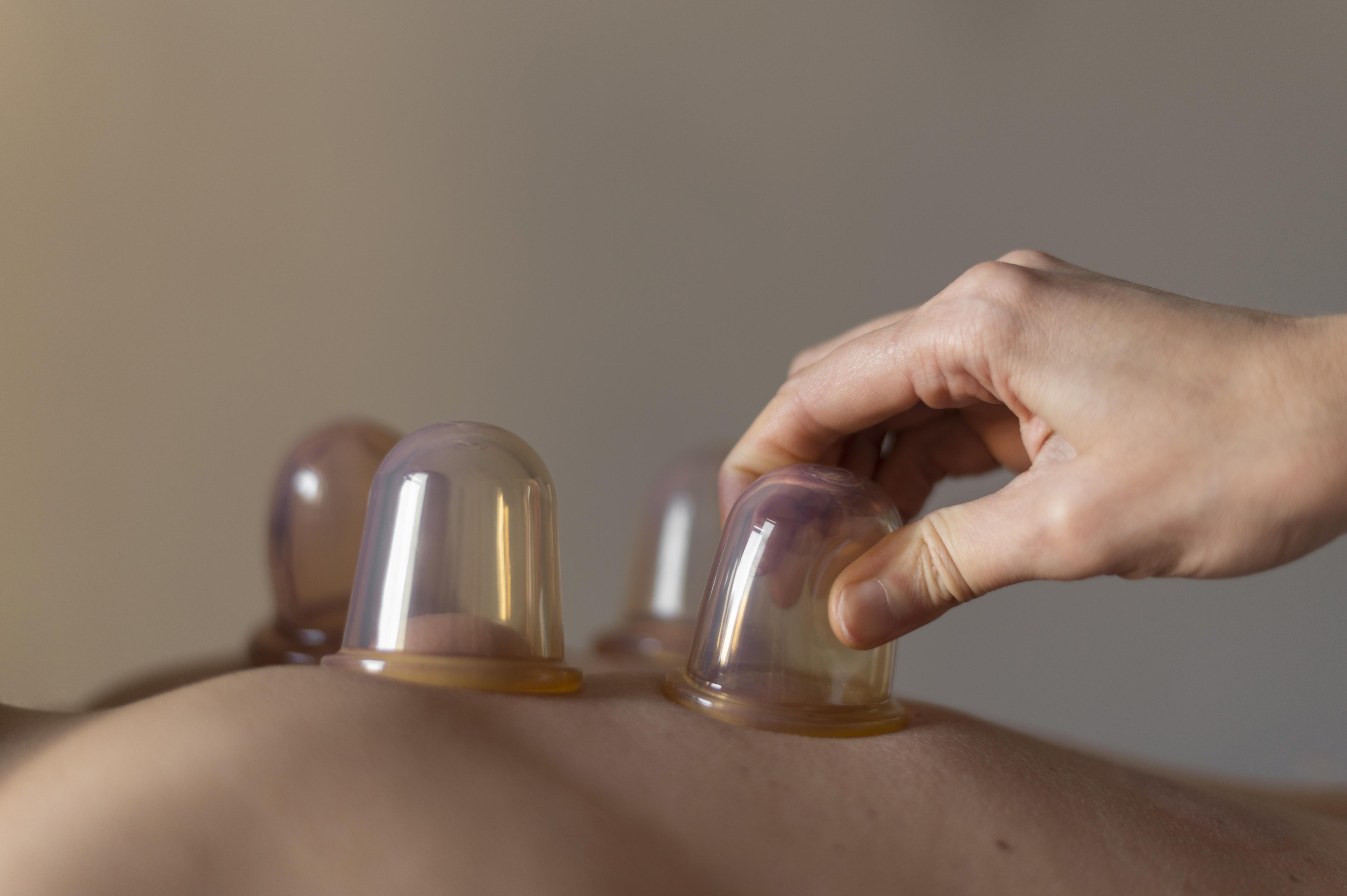 Dry Cupping Therapy (Hijama)