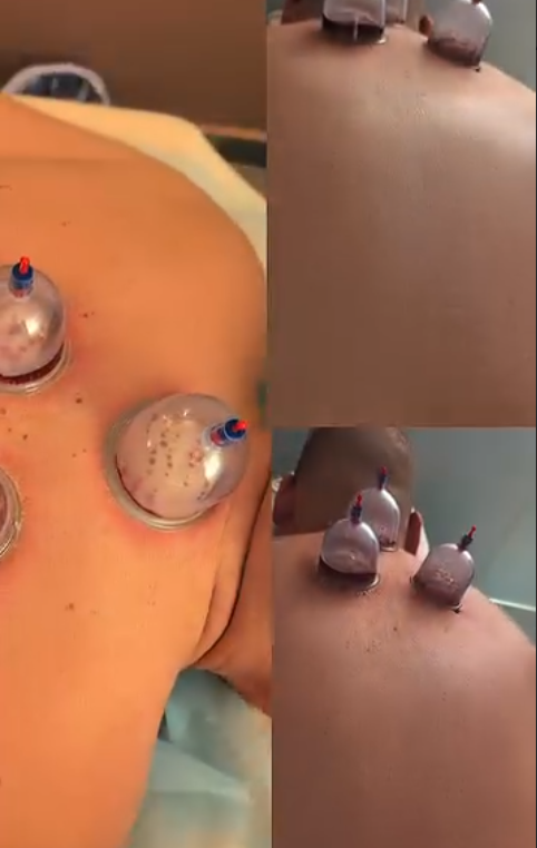 Wet Cupping Therapy Session (Traditional Hijama)