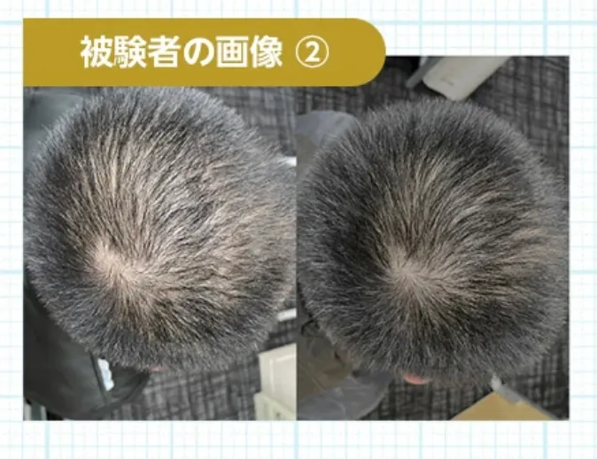 REDEN Hybrid Hair Growth Tonic (90mL) - 100% Made in Japan | High-Potency 3% Redensyl