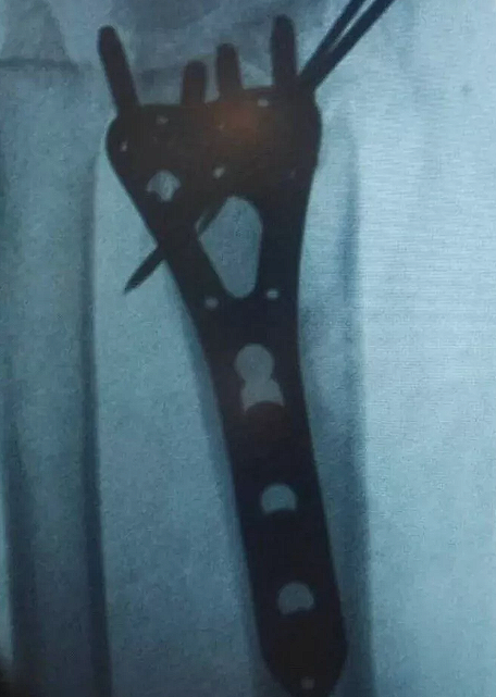 Distal Radius Volar Locking 2.7mm plates 2 to 5 holes L &R screws Set of 86