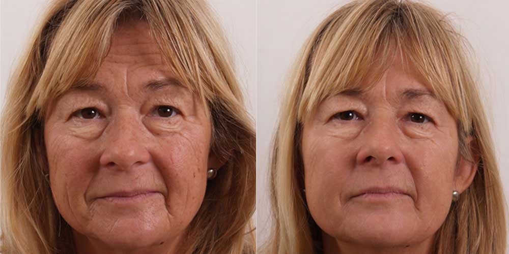 RADIOFREKVENSSI HOITO KASVOILLE JA KAULALLE  65 min