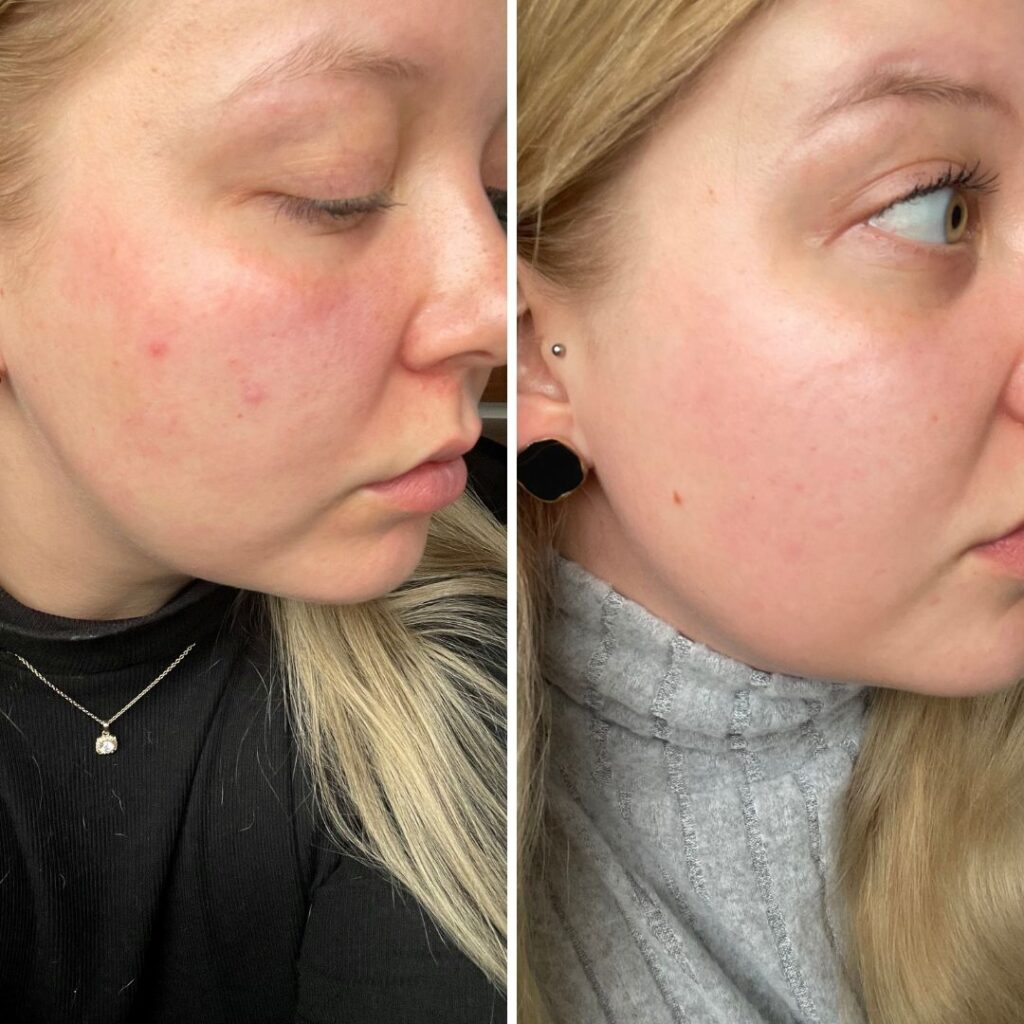 Nuorten ihon puhdistus  60 min