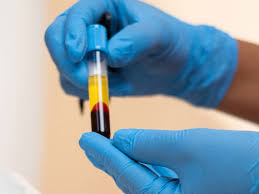 Plasma Rico en Plaquetas / Facial