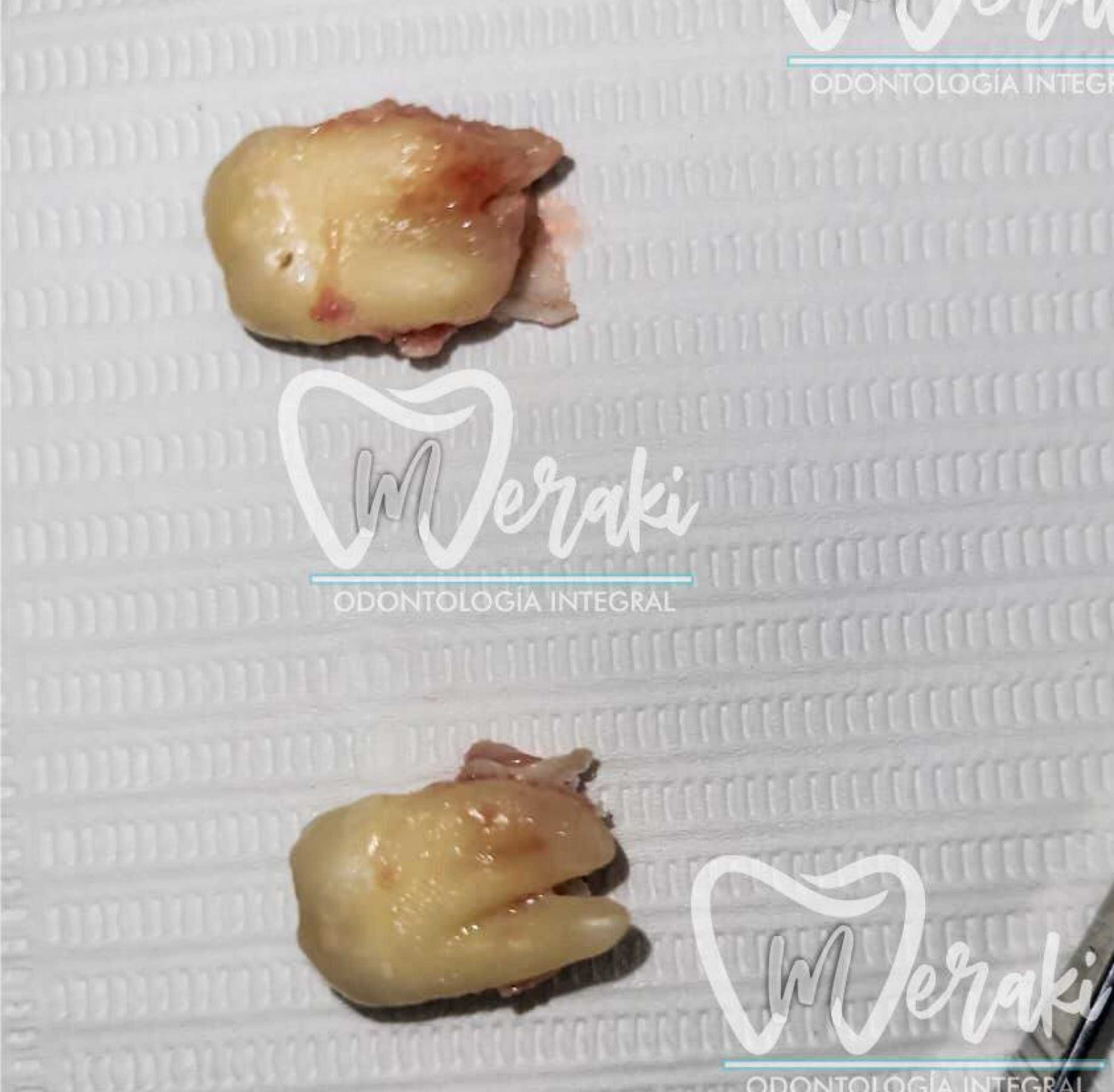 Extracción Simple de Muela del Juicio