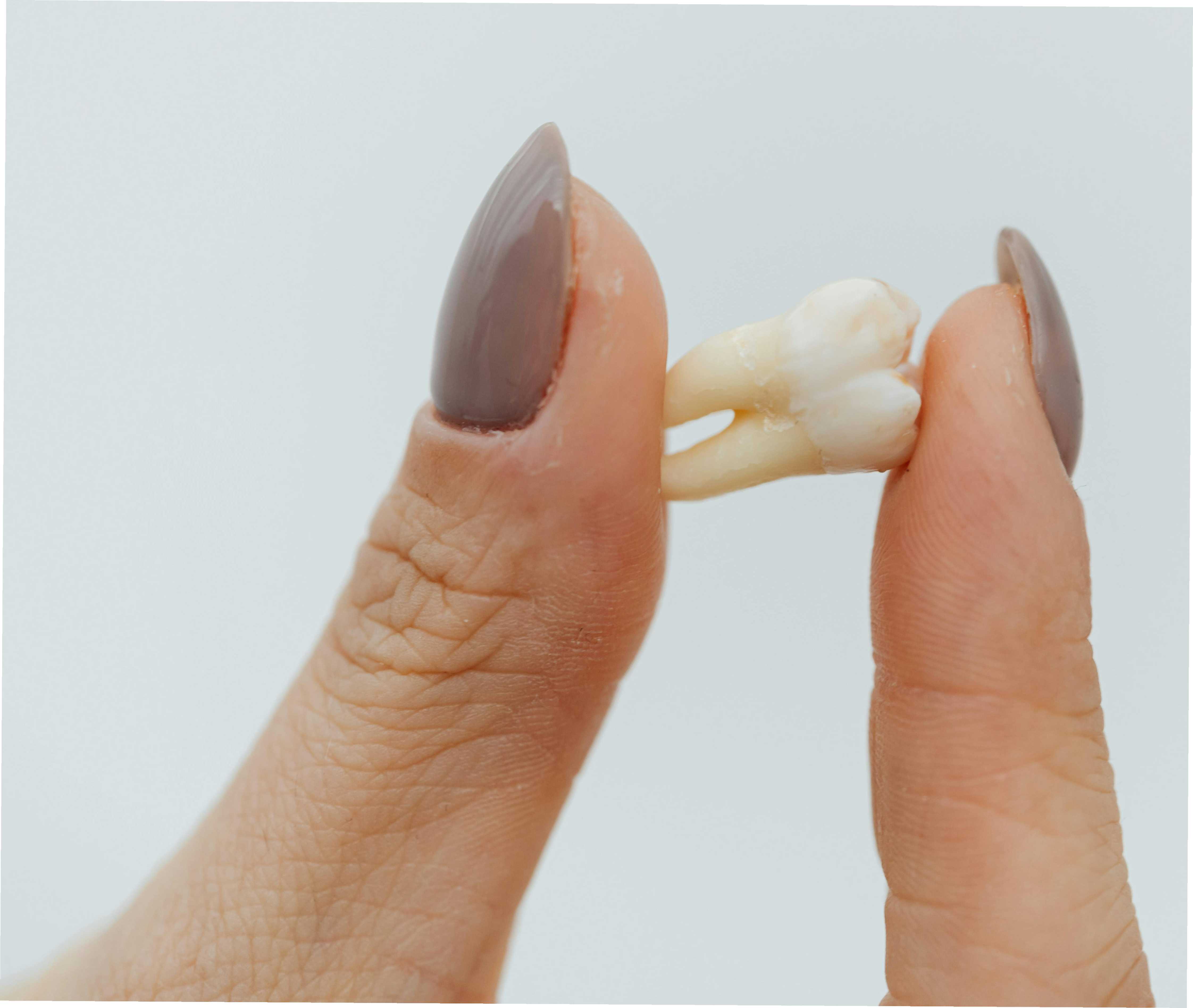 Extracción Dental Simple