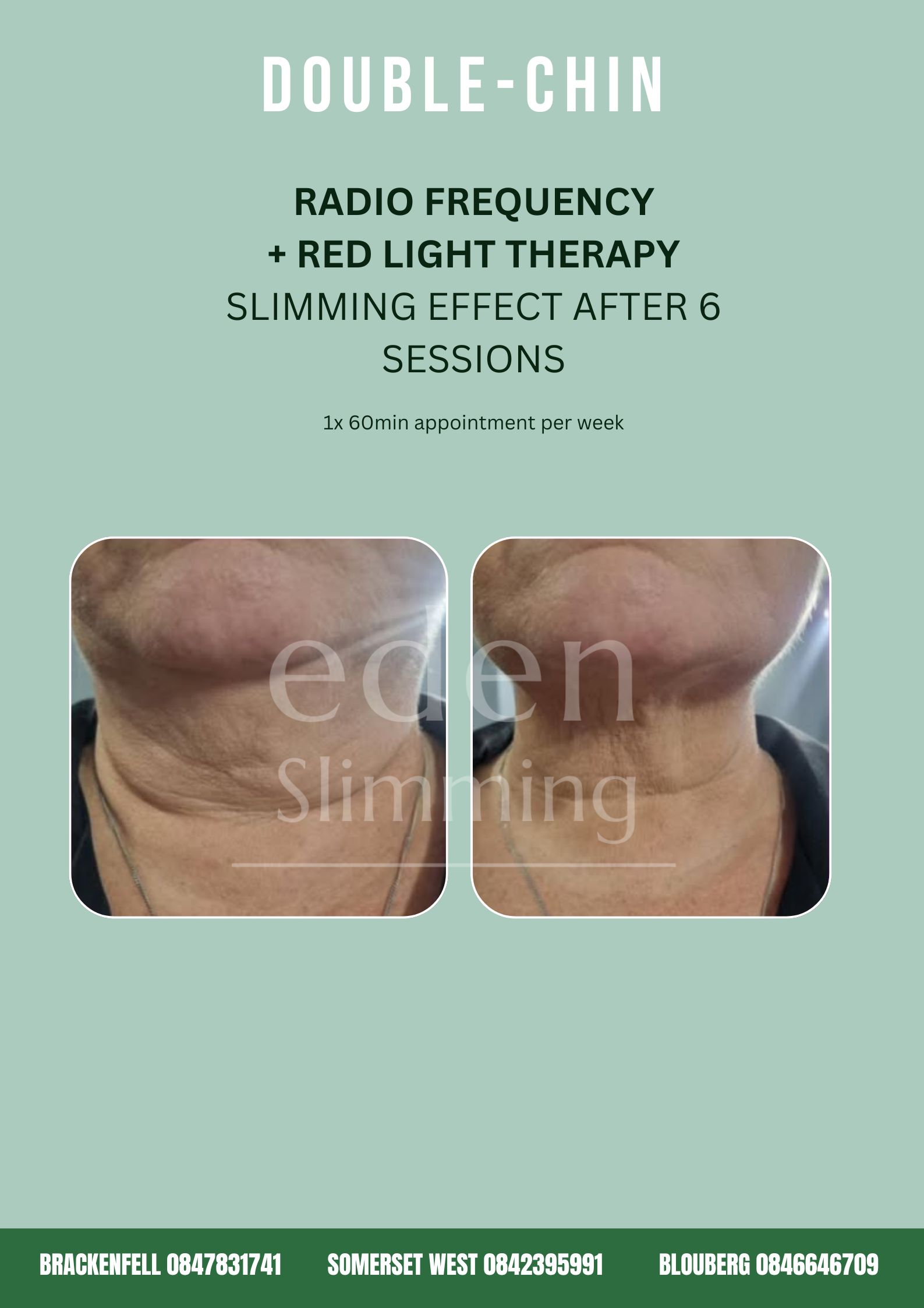 Jawline and Neck Contouring