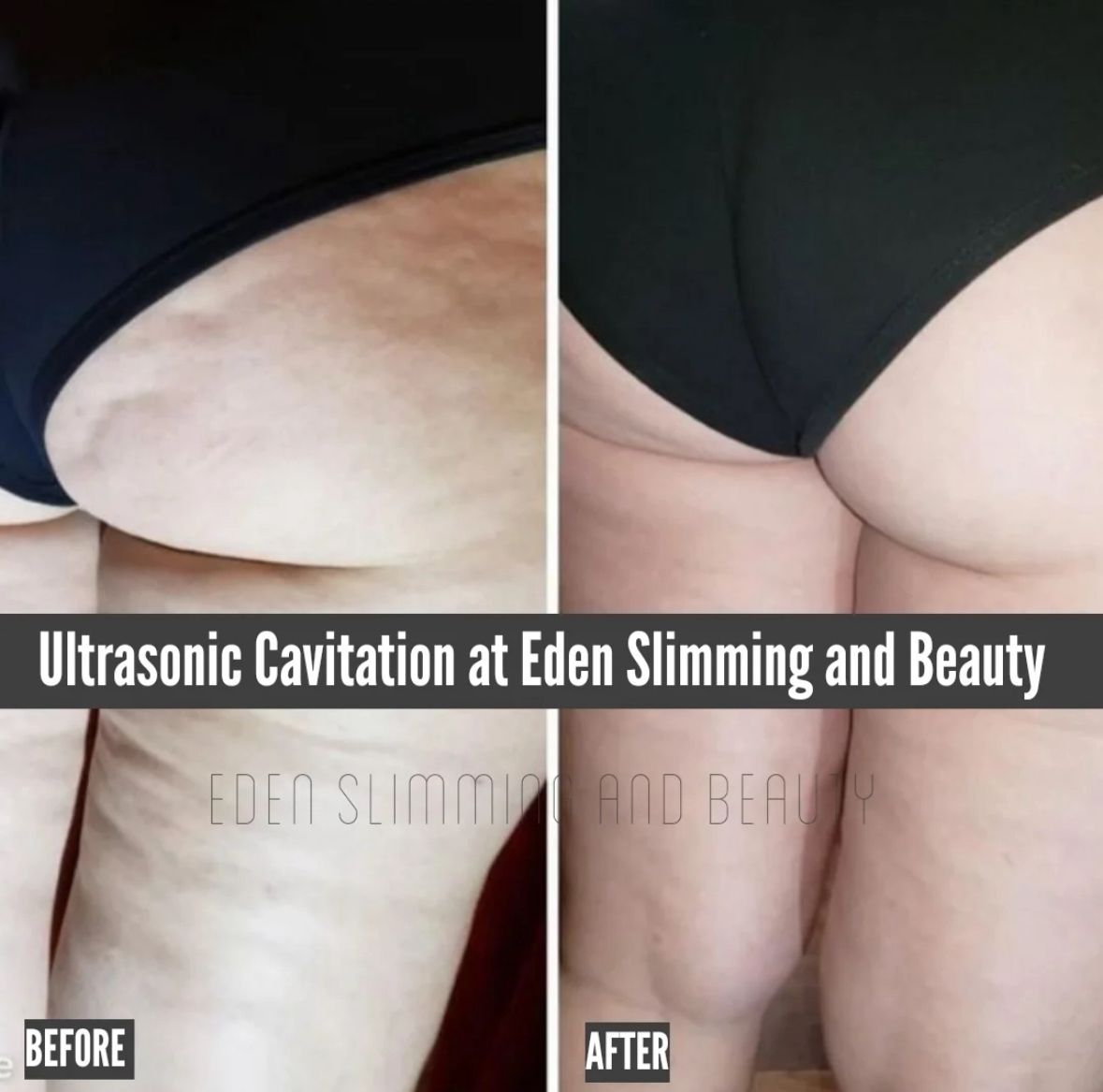 Cellulite & Smoothing Treatment
