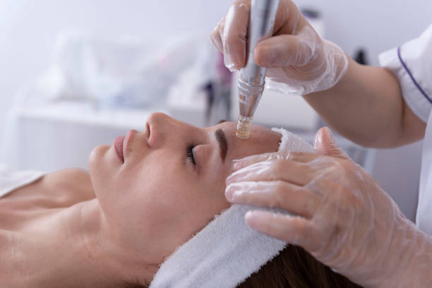 Microneedling - Full Face