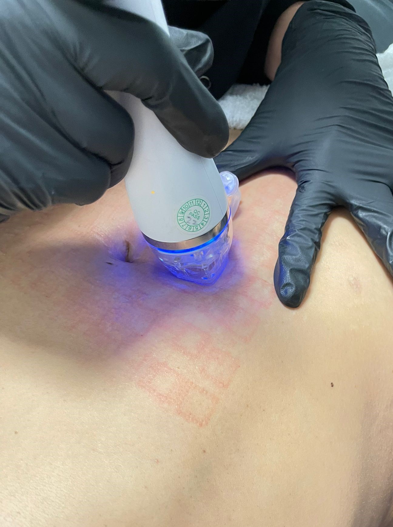 RF Microneedle with PRP and Stem Cells - Body & Scars (Small Area)
