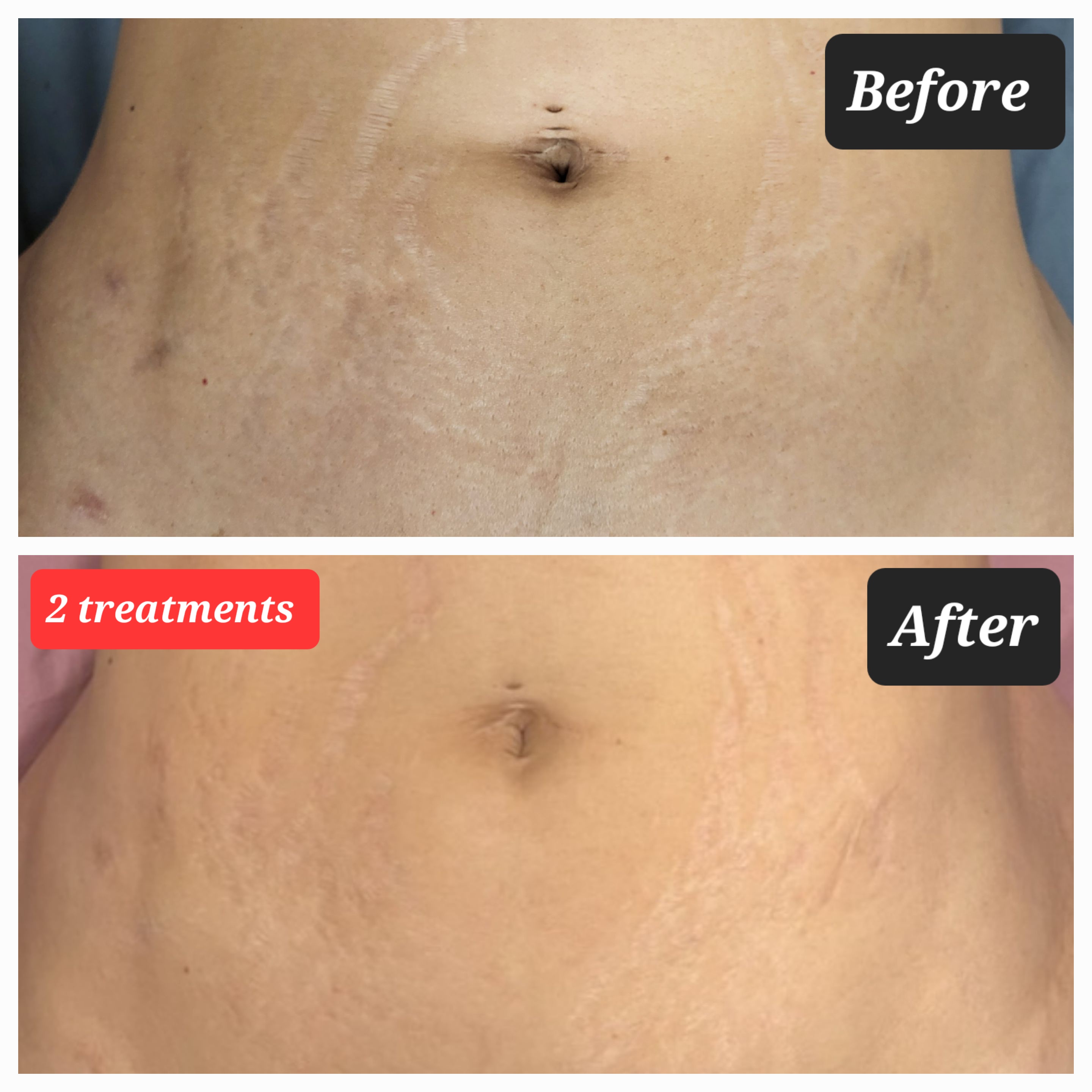 RF Microneedle with PRP and Stem Cells - Body & Scars (Large Area)