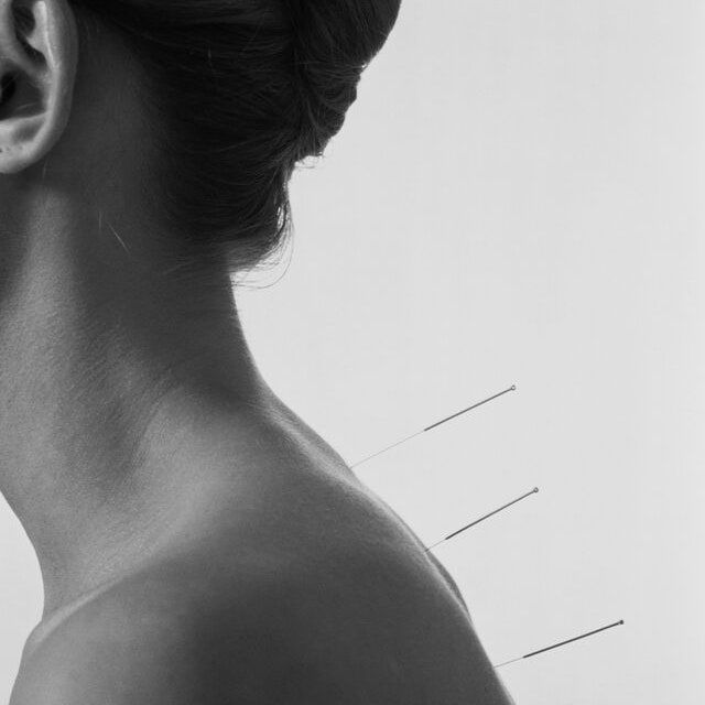 (Concession) Follow Up Acupuncture