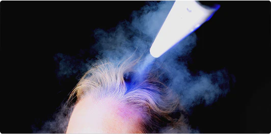 Hair Loss Prevention $100-300 PRICE PER TREATMENT