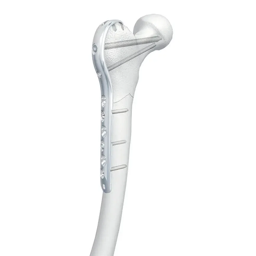 Placa Periarticular Bloqueada Fémur Proximal con Gancho