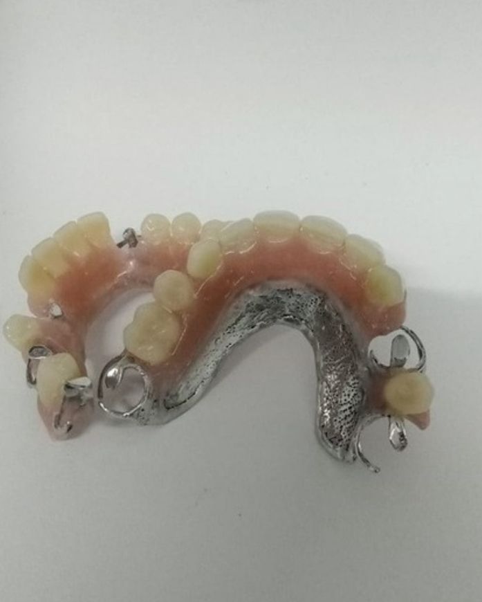 Prótesis removible estructura metálica 