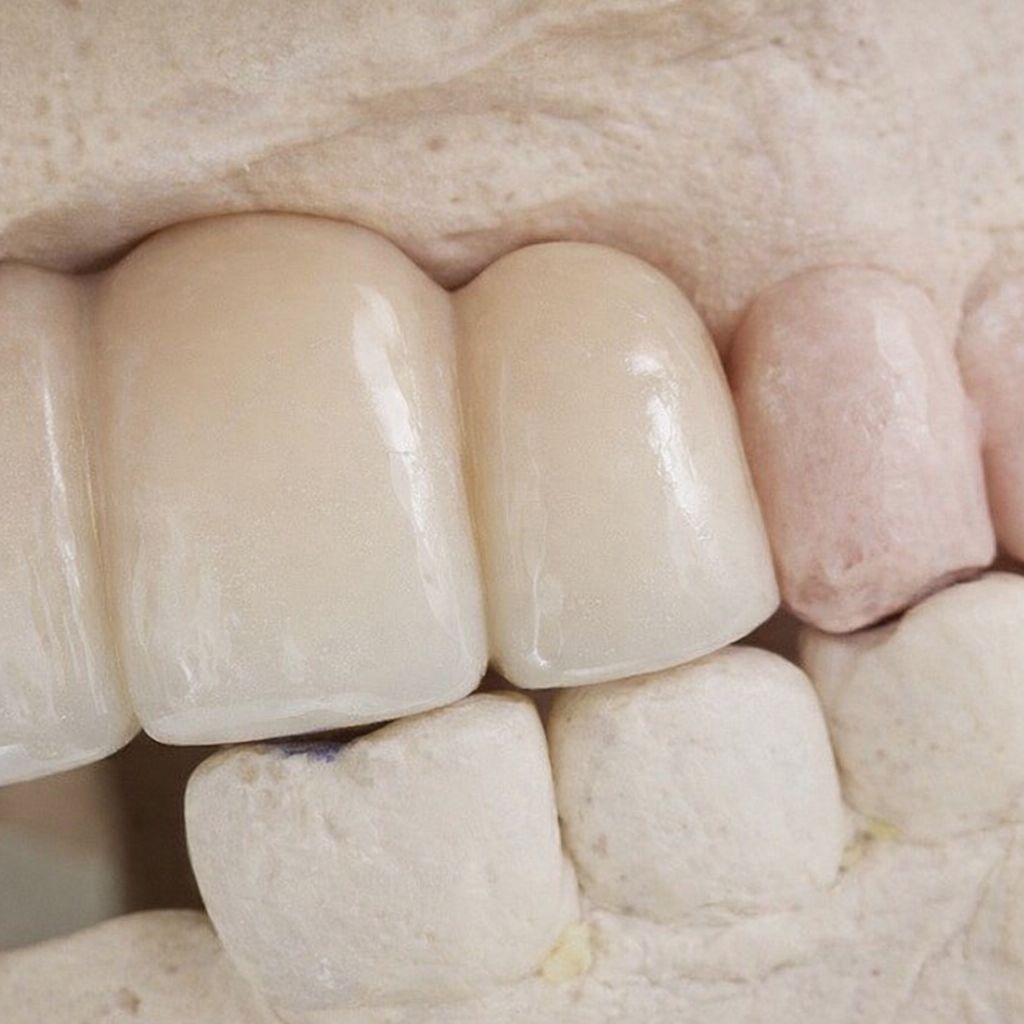 Reparación de dientes en acrílico 