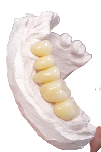 Provisionales termocurados 