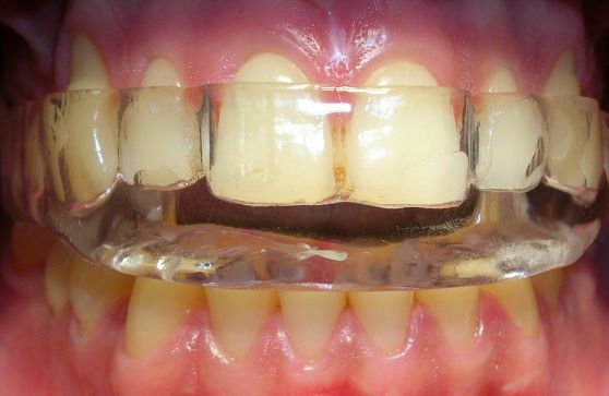 Placa neuromiorelajante 